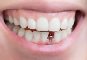 Implanty zębów Warszawa