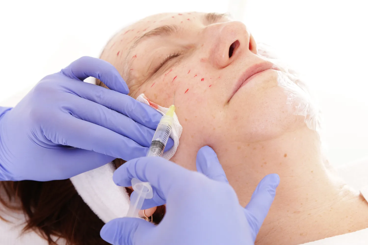 Co daje kwas hialuronowy na twarz?